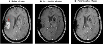 CD19 and CD70 Dual-Target Chimeric Antigen Receptor T-Cell Therapy for the Treatment of Relapsed and Refractory Primary Central Nervous System Diffuse Large B-Cell Lymphoma